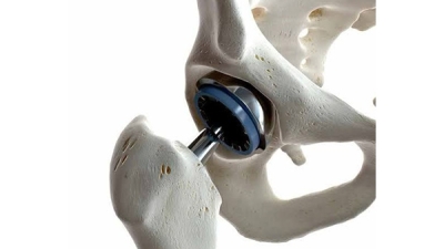 Hip-Replacemento.jpg