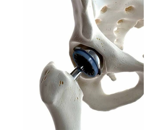 Hip-Replacemento.jpg